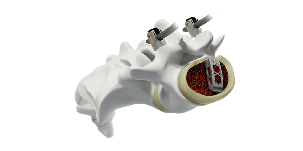 Medtronic Launches Proprietary Surface Technology on AM Devices
